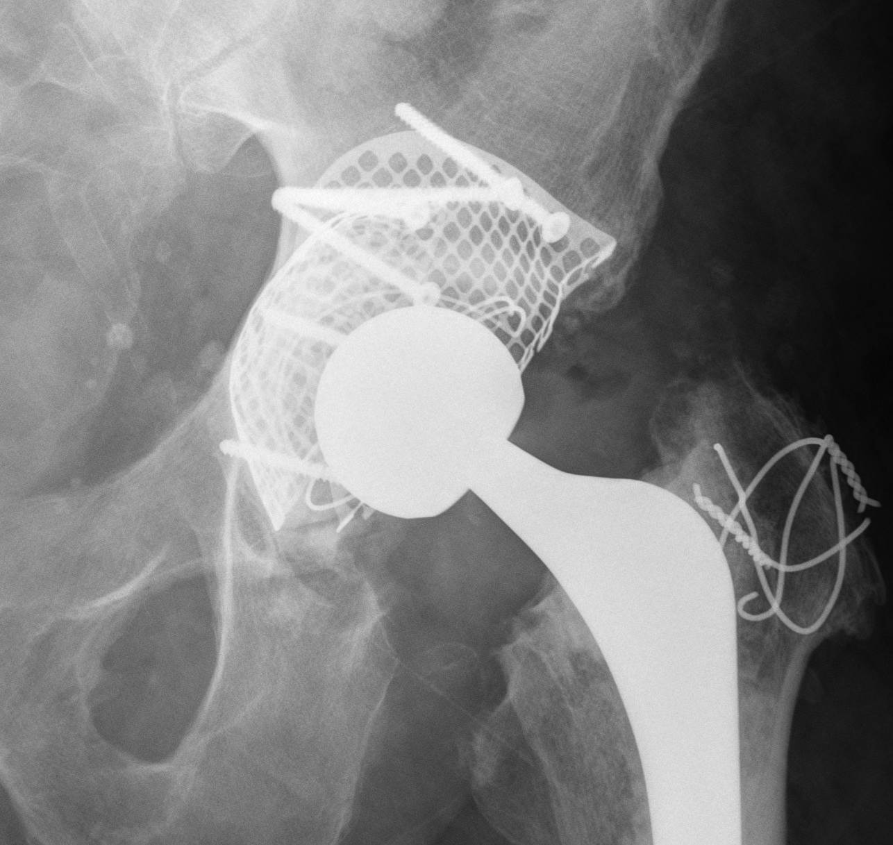 Revision Acetabulum Type IIC Impaction Bone Grafting